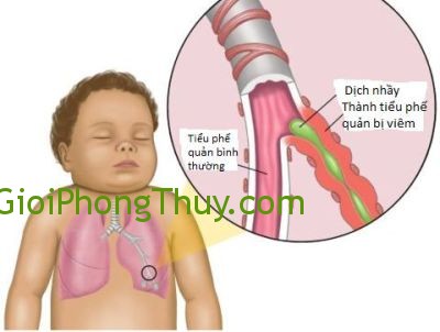 Mơ với viêm phế quản